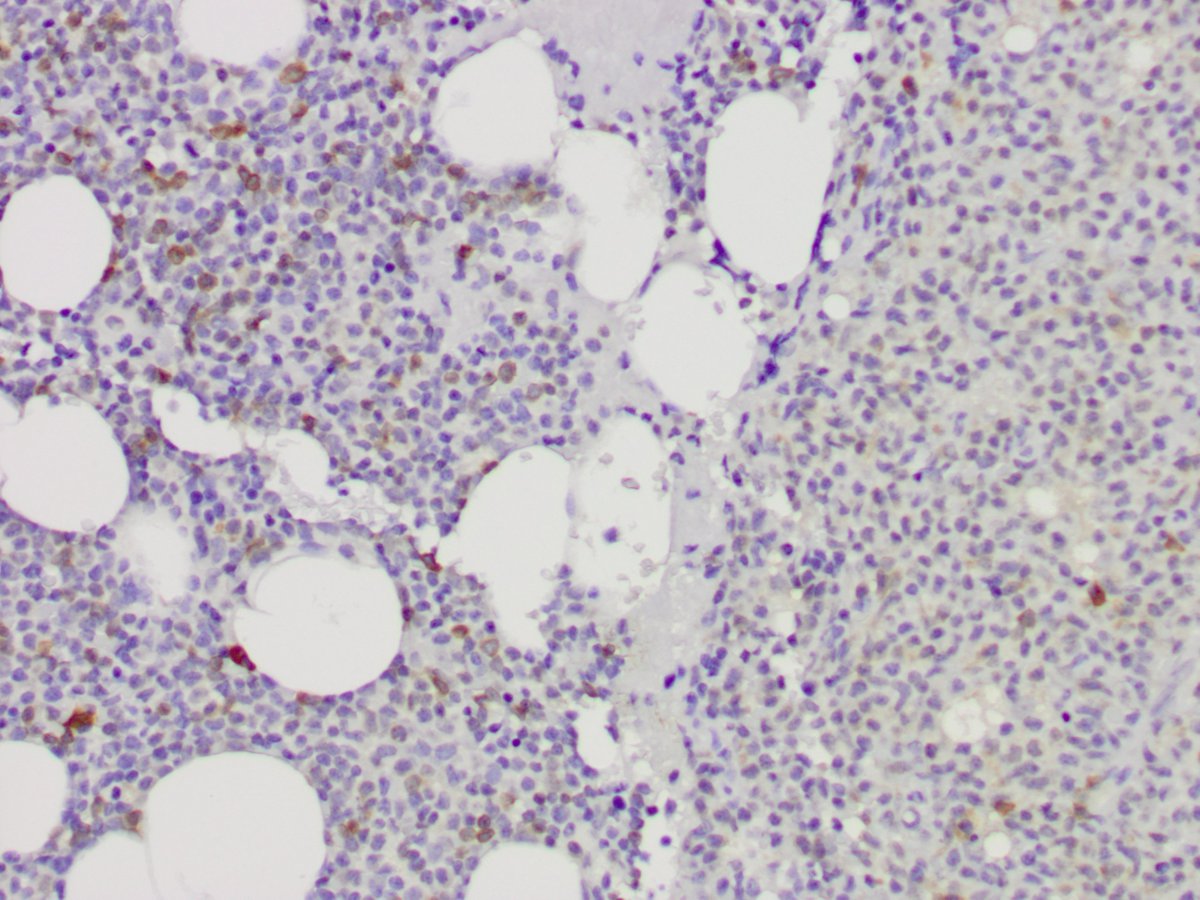A subset of the blasts expresses CD79a, while the plasmacytoid dendritic cells are negative